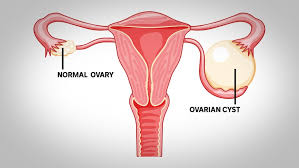 ovarian cysts